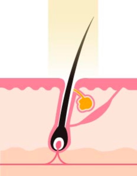 エステ脱毛（一時的な減毛）イメージ