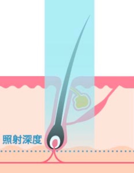 医療レーザー脱毛（永久脱毛）イメージ①