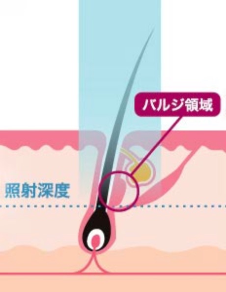 医療レーザー脱毛（永久脱毛）イメージ②